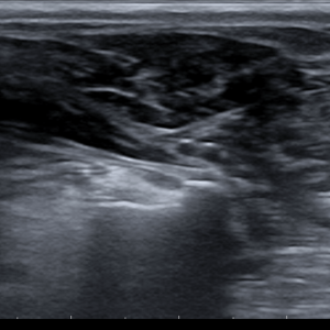 ECOGRAFÍA DE LA EXTREMIDAD POSTERIOR: CADERA, PSOAS, MUSCULATURA, TUMORES DE PARTES BLANDAS Y TARSO