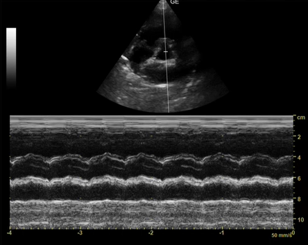 hipertension pulmonar