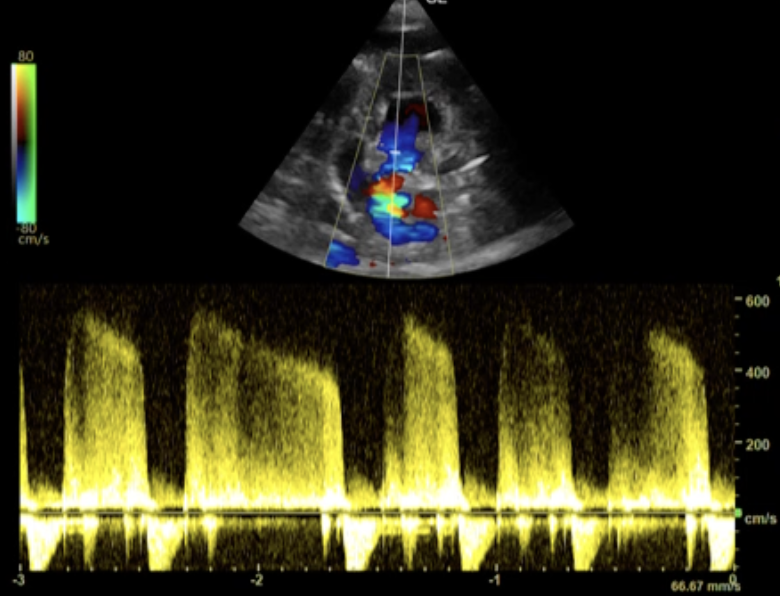 ENFOQUE ECOCARDIOGRÁFICO DE LA HIPERTENSIÓN ARTERIAL SISTÉMICA